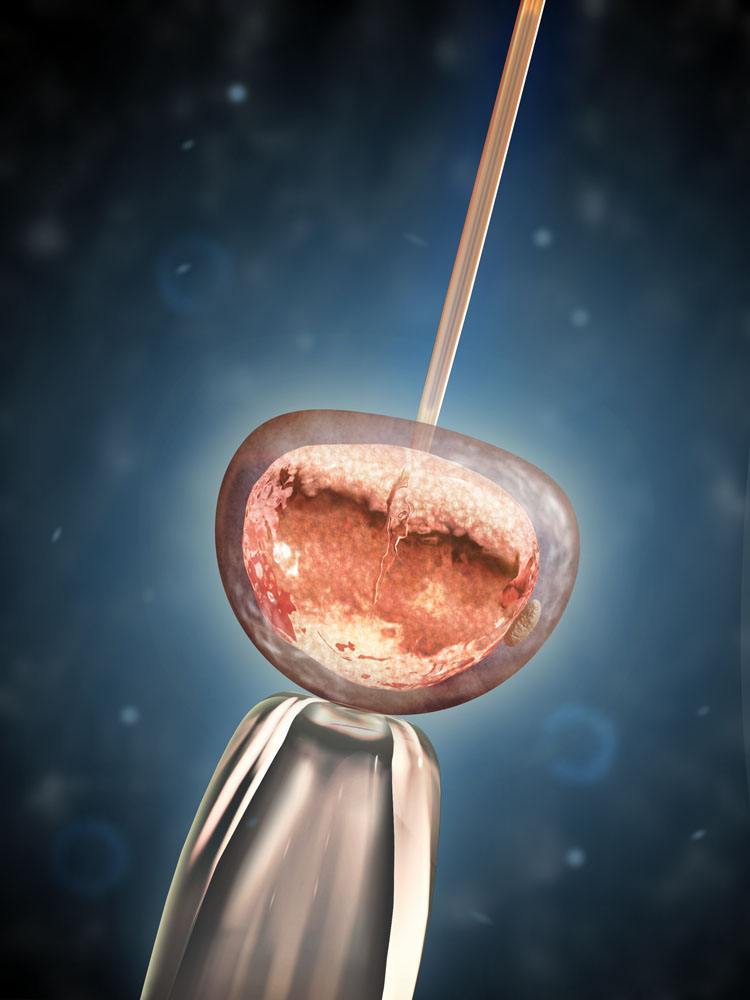 试管婴儿技术助孕费用分析